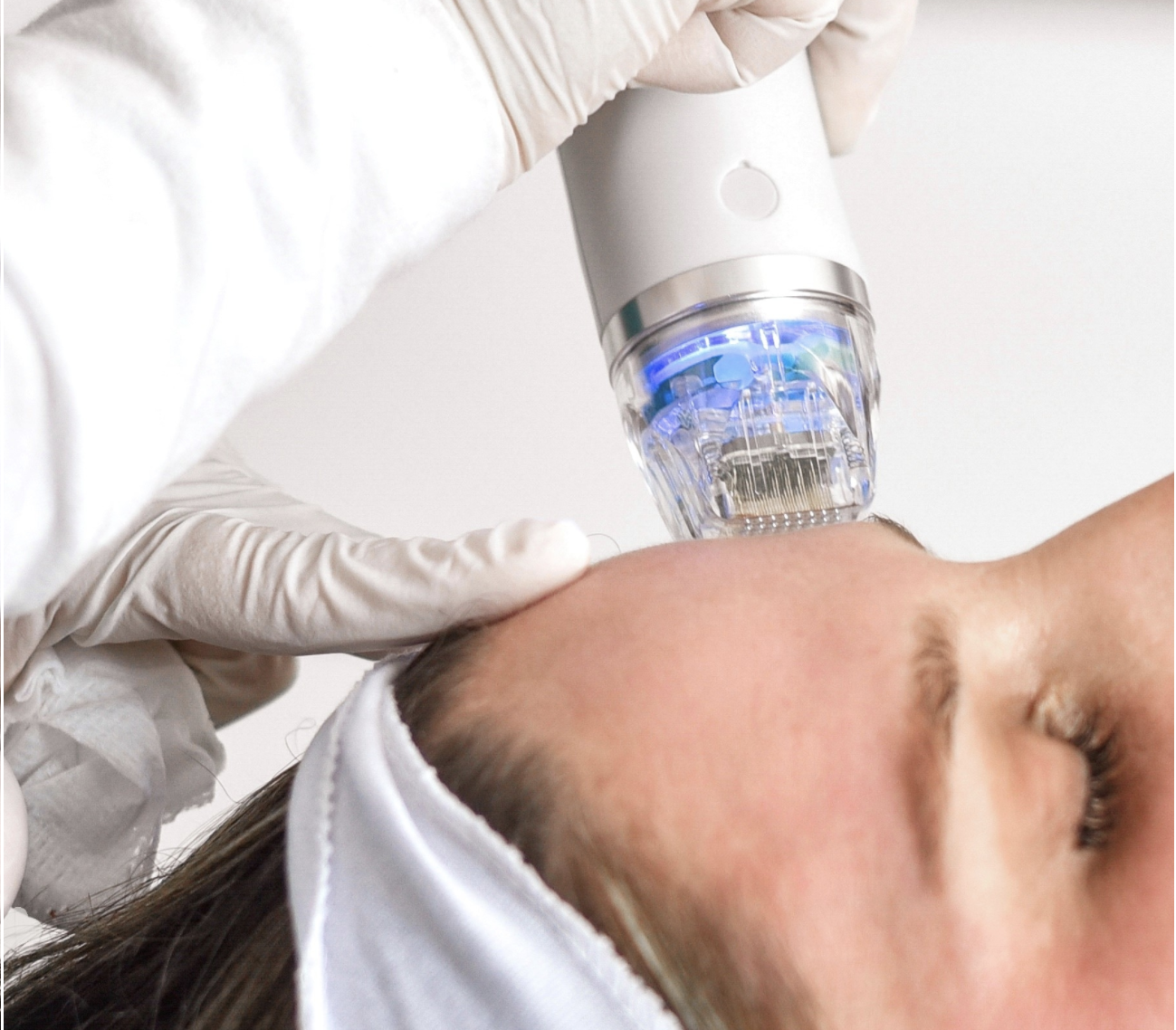 RF Fractional Microneedling