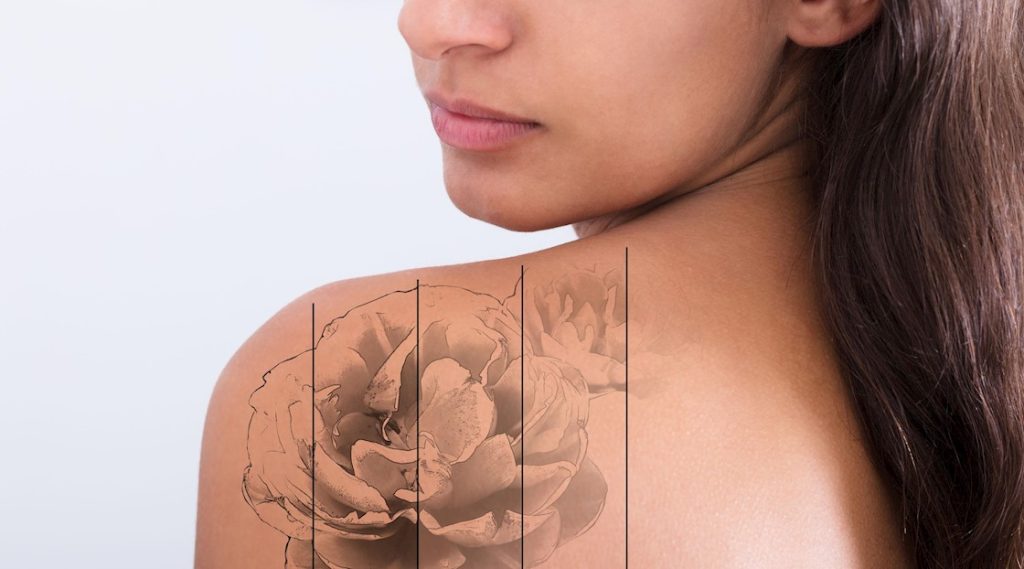 Laser Tattoo Removal